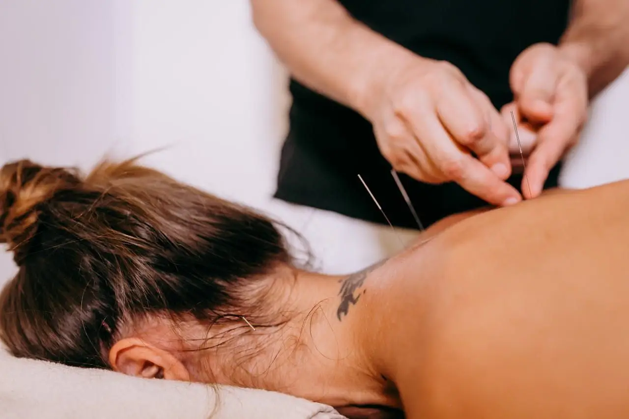 our-experience Close-up of acupuncture needles being inserted on a woman's back during therapy, promoting relaxation and wellness.